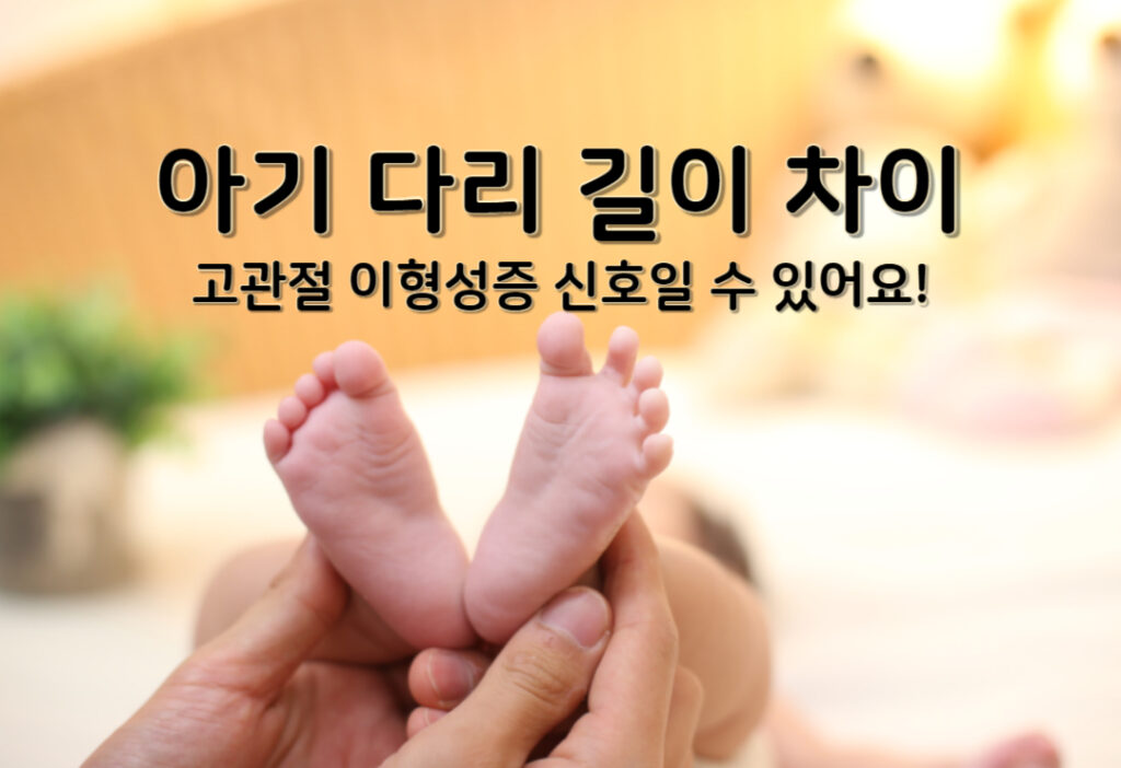 아기 다리 길이 차이, 고관절 이형성증 신호일 수 있어요!