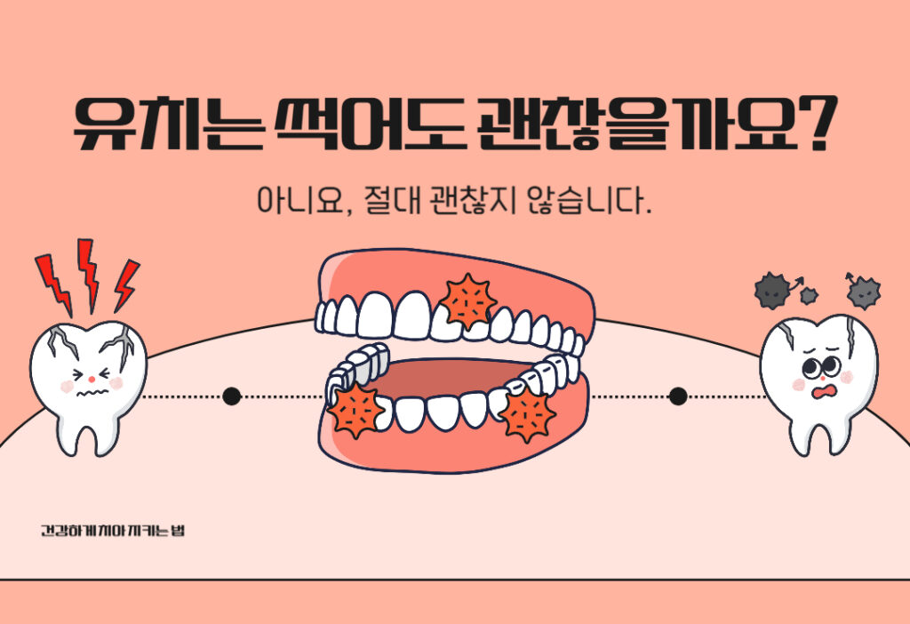 유치는 썩어도 괜찮을까요? NO! 유치 관리가 중요한 이유